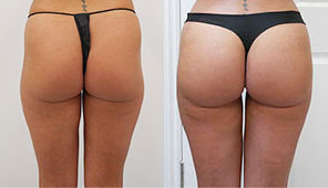 before after photos Cosmetic surgery london vaser liposuction