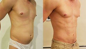 before after results Cosmetic surgery london brazilian butt lift