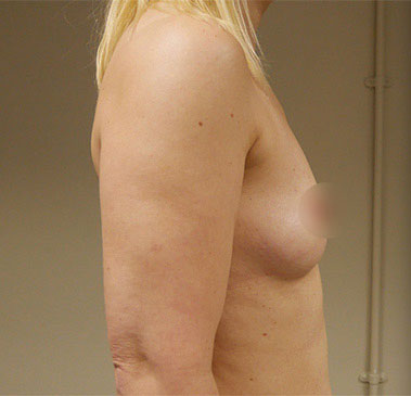 Vaser Liposuction Before & After Patient #246
