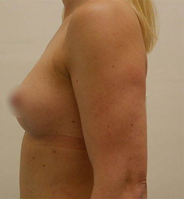 Vaser Liposuction Before & After Patient #246
