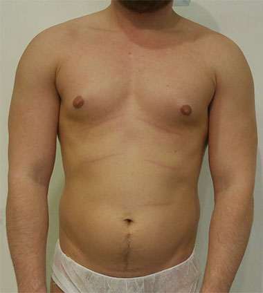 Vaser Liposuction Before & After Patient #215