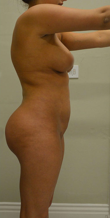 Vaser Liposuction Before & After Patient #196