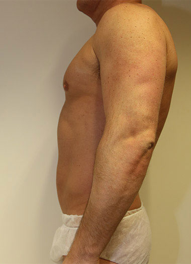 Vaser Liposuction Before & After Patient #186