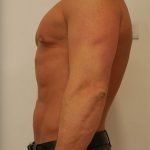 Vaser Liposuction Before & After Patient #186