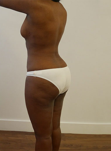 Vaser Liposuction Before & After Patient #177