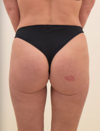 Vaser Liposuction Before & After Patient #279