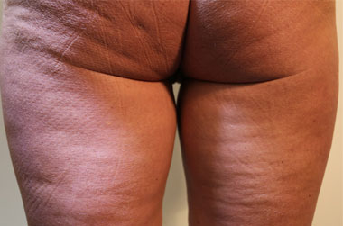 Vaser Liposuction Before & After Patient #279