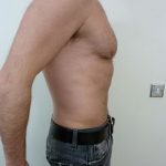 Vaser Liposuction Before & After Patient #285