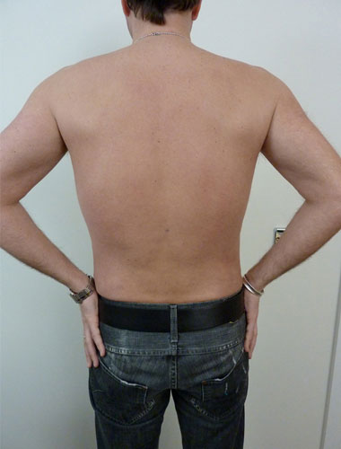 Vaser Liposuction Before & After Patient #285