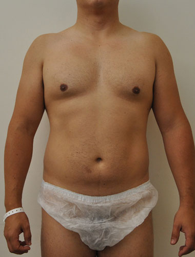 Vaser Liposuction Before & After Patient #299