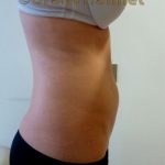 Vaser Liposuction Before & After Patient #308