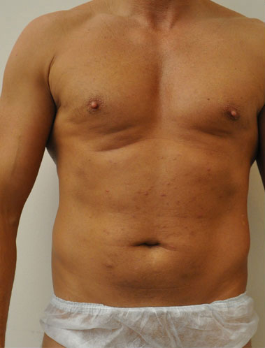 Vaser Liposuction Before & After Patient #313